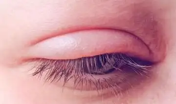 上眼皮肿因何而起如何消肿效果好需打通血液循环