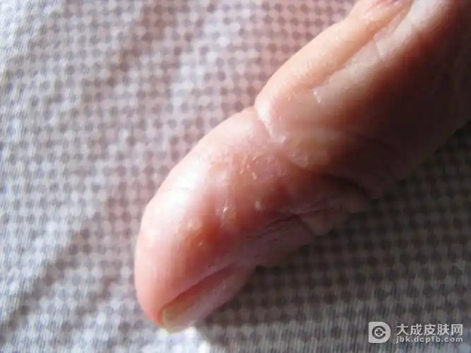 急性湿疹症状是什么