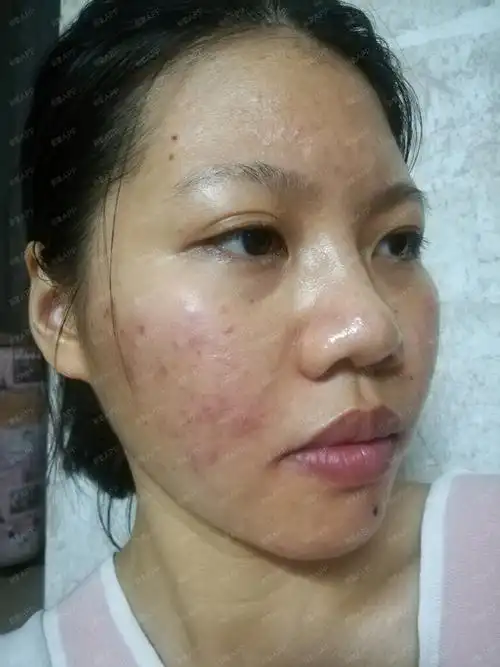 今天是我做果酸换肤的第一天,也是第一次做果酸换肤,_圈子-新氧美容