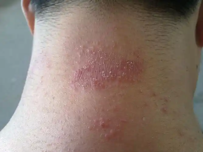 问:这是什么皮肤病?怎么产生?怎么治疗?如何预防?