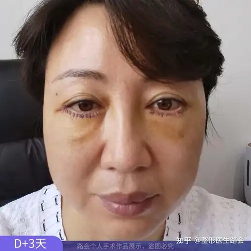 刚做完膨体泪沟填充90天,作为过来人,跟大家提个醒!