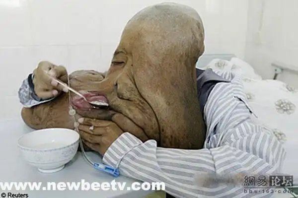 世界罕见的恐怖怪病