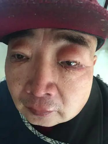 眼睛有浮肿,有异物,他本人有糖尿病,也中风了几年了.