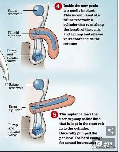 一出生就没有jj,好不容易装了个假的,啪啪后又被搞进医院