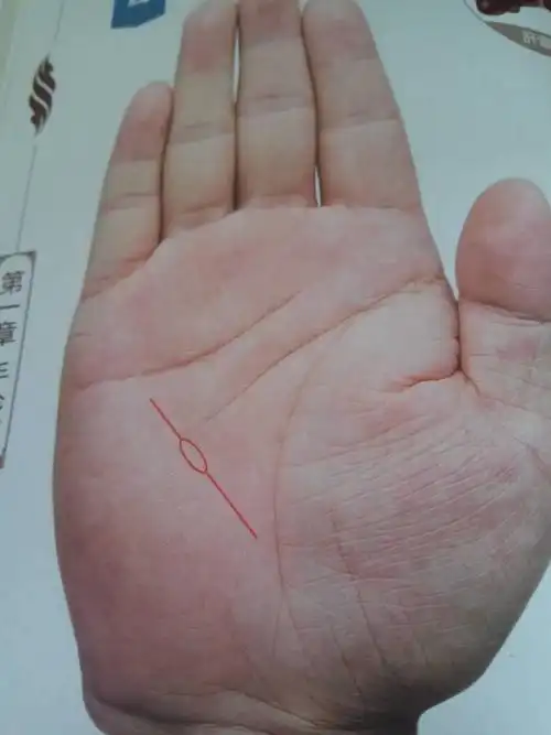 非健康线上出现岛纹,易患肝囊肿