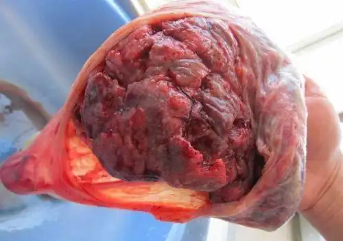 前置胎盘可以引产吗