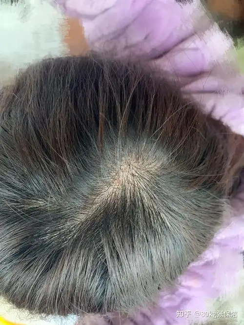 头皮毛囊炎有没有什么好的治疗方法? - 知乎