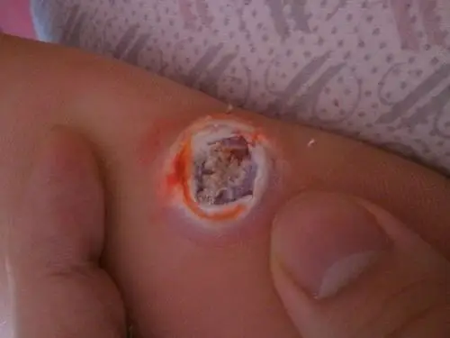 鸡眼根部挖出图片 (9)