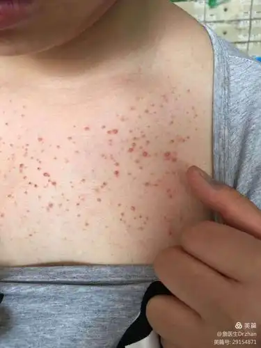 其它 马拉色菌毛囊炎 写美篇本病男性多于女性,16-40岁好发.