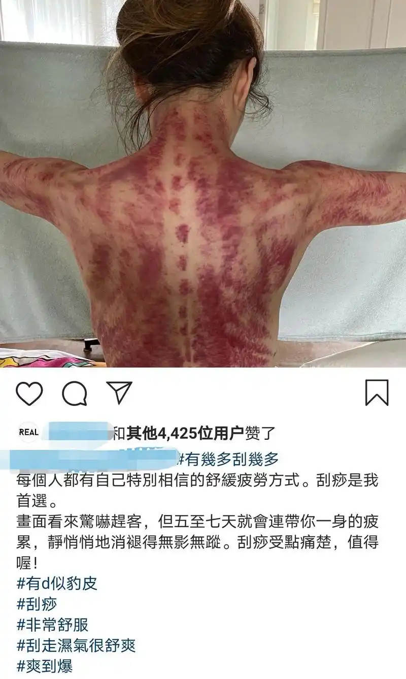 晒刮痧照吓坏粉丝,自拍照瘦得让人心疼,"颠覆"美形象的郑秀文