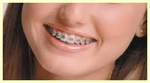 女24岁,牙齿咬合问题,需要矫正牙吗