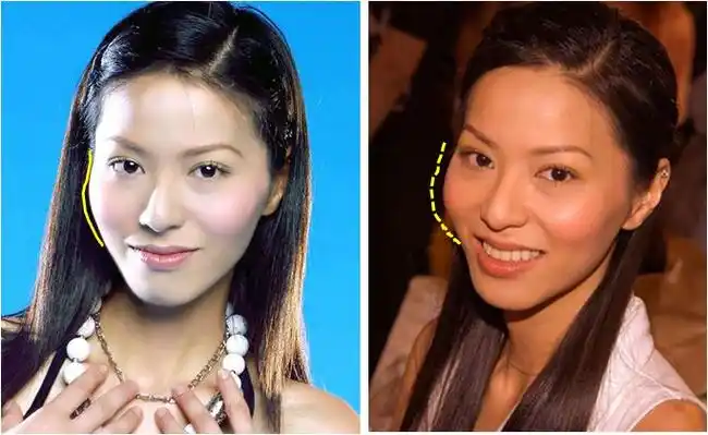 颧骨高和宽是克夫相的象征,因此才会有很多人选择磨骨改变脸型