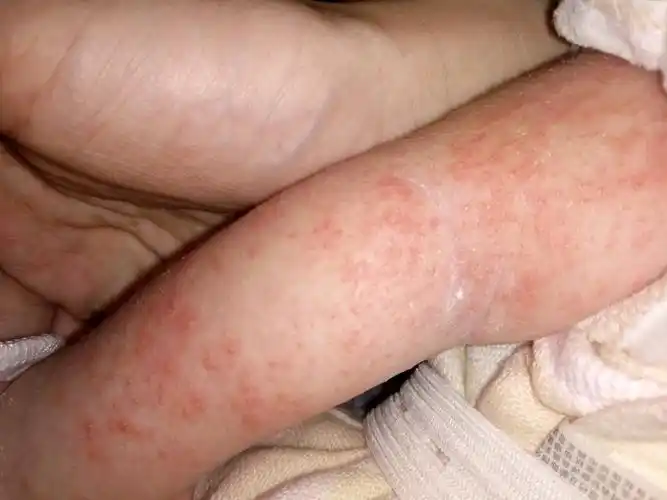 这些是不是热毒