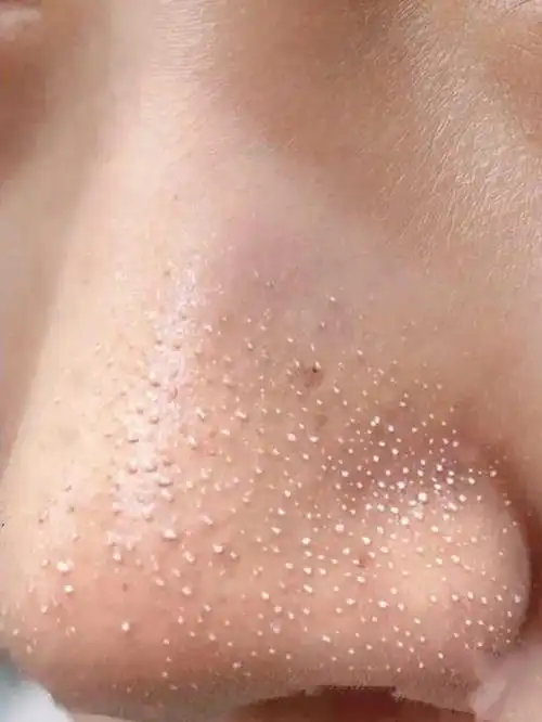 油性皮肤有黑头毛孔粗大怎么办?用什么能去除黑头和收缩毛孔?