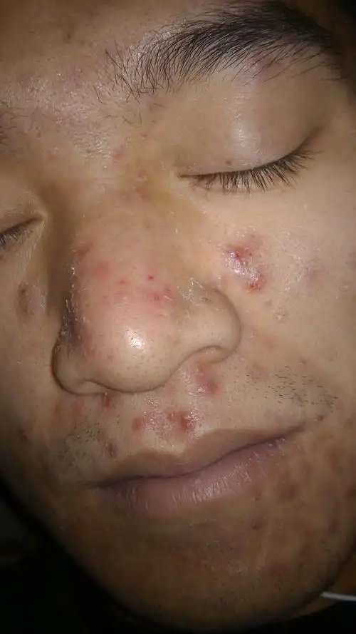 请问各位老师我这是脂溢性皮炎吗还是什么搽什么来的快,有人说复方