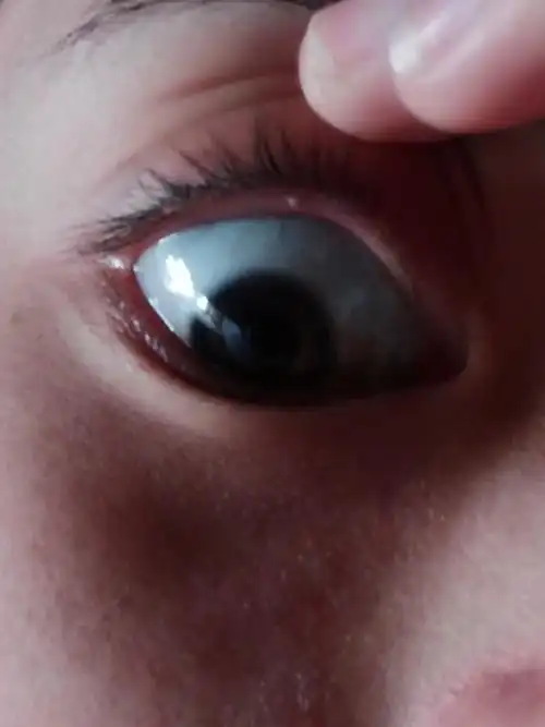 眼皮下面上了个像痘痘的东西,这是什么啊