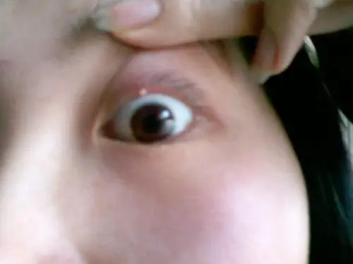 我上眼皮(里面哦)长了俩个针眼大小的白点,请问是啥?怎么治疗?