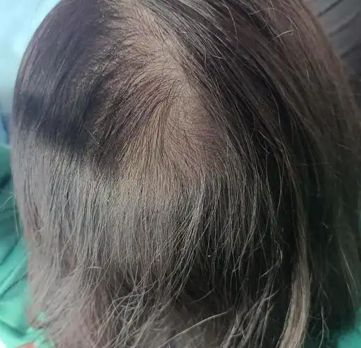 有没有跟我一样,发际线完美,其他地方都秃的要命