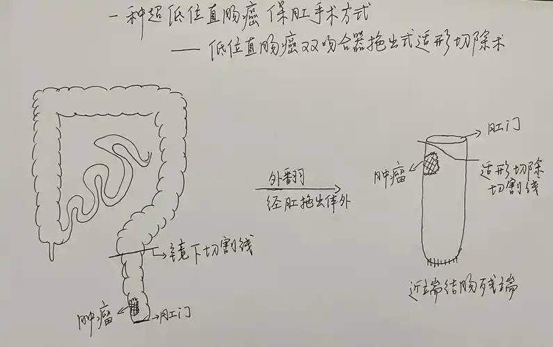 巧施妙招,超低位直肠癌患者保肛梦成真