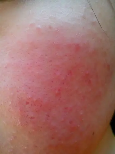 脸上长痘痘,吃了中药之后,变得更多了而且发红,不是皮肤病吧?