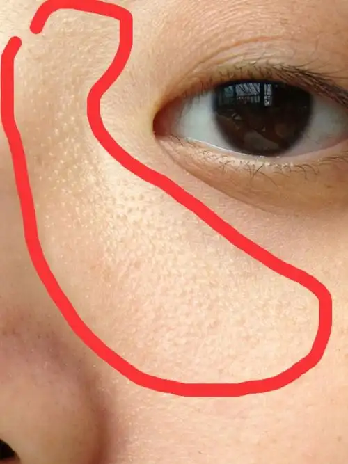 闭口粉刺这个小妖精,有谁能把她灭了吗