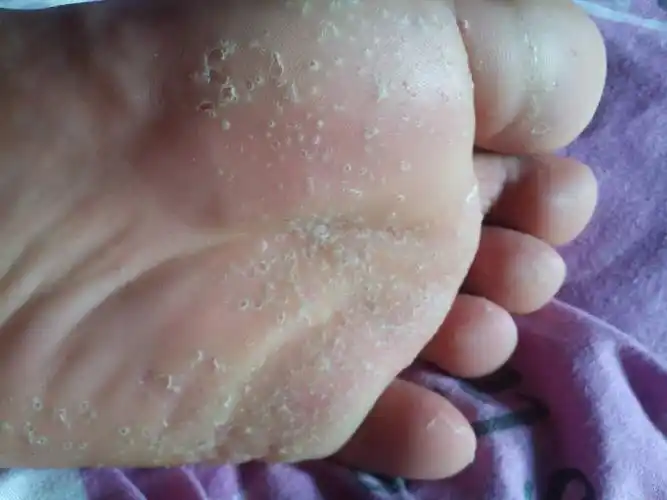 我什么我脚底板还起白色小洞?