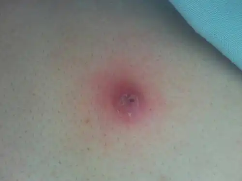 后背上固了一个包,不痛不痒,有一年左右了 之前挤