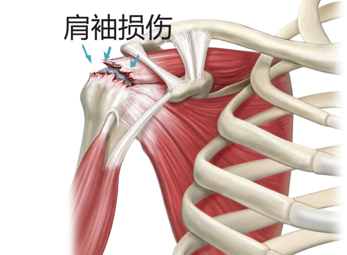 症状:疼痛加肩关节无力,或肩关节不能主动做外展,上抬,内外旋等动作
