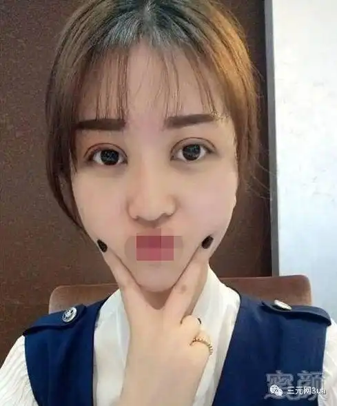 8mm平行双眼皮恢复日记