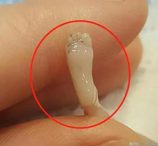 宝妈怀孕14周意外流产,"胎儿"模样曝光!才10厘米但手脚已成形