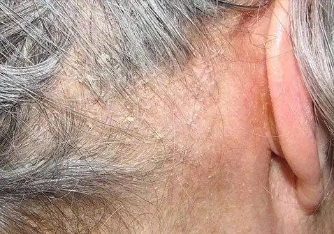 严重头皮屑图片严重的脂溢性皮炎(头皮屑)很难与头皮牛皮癣区别开来