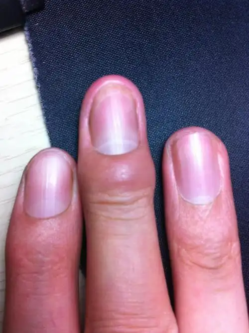 由于长时间的挤压造成的血液循环不好造成的,引起关节骨膜的肿胀发炎