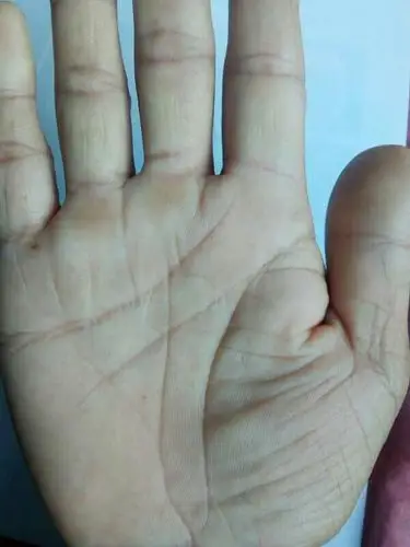 掌纹与健康(1线)