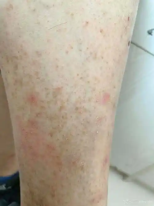 双下肢对称性褐色斑点2年余无不适皮肤淀粉样变