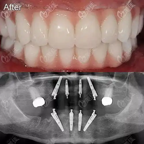 70岁老人在北京瑞泰口腔丰台医院用4颗种植体解决了半口牙缺失