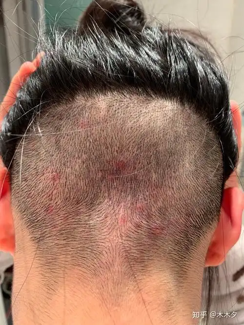 头皮上发毛囊炎该怎么办