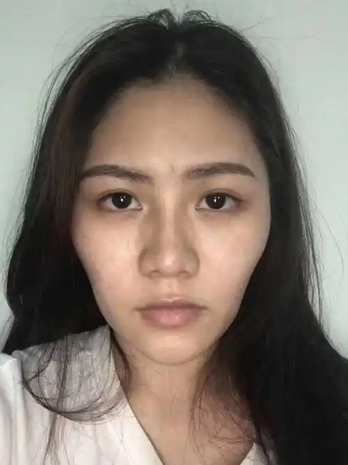 自体脂肪填充面部能保持多长时间