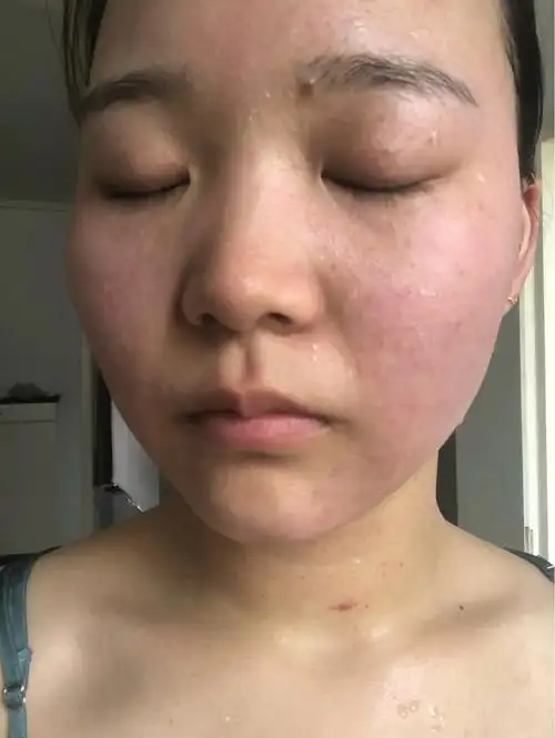 脸干 起皮 爱泛红 角质层变薄了应该用什么护肤品?怎么修复敏感肌?