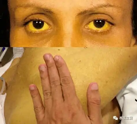 梗阻性黄疸不用慌,核医学显像来帮忙!_诊断_胆管_检查