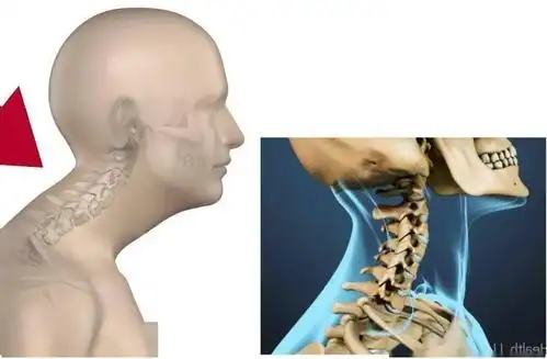 颈因性头痛-搜狐大视野-搜狐新闻