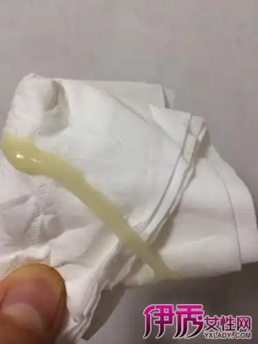【图】女人怀孕有白带吗 带你一起了解什么是正常的白带