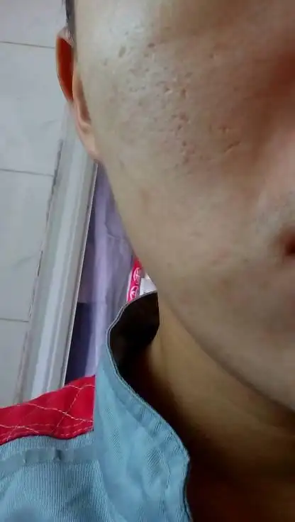 请问我的脸毛孔大!又有凹凸的孔,怎么办?好像越来越多!两边都会!