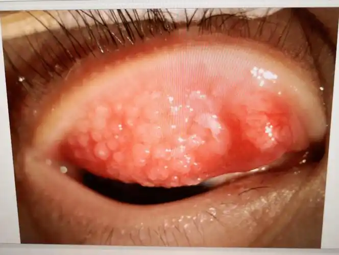 12岁小孩翻开眼皮,竟然密密麻麻都是这个东西._小江_视力_检查