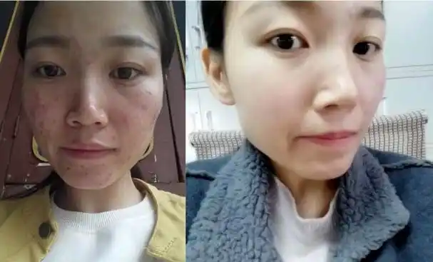 达人李梦晨分享祛痘经验,原来祛痘可以这么简单!