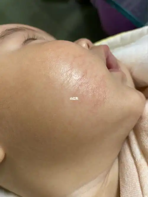 宝宝脸上红血丝该怎么办呢?擦了很多牌子的霜都不管用