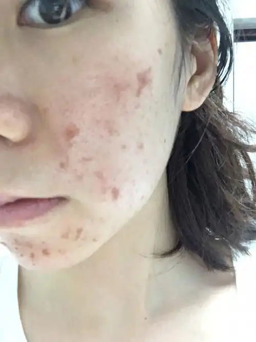 来来来…放波大招…果酸换肤第二天