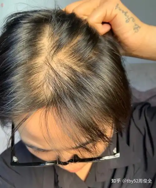 女生发量少头顶快秃了有没有什么好的防脱发的方法跪求