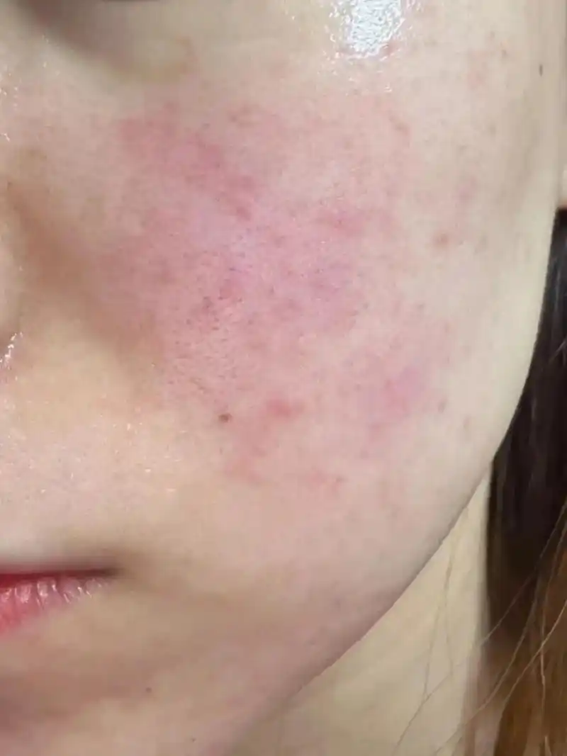 才知道去红脸蛋这么简单.脸上没有红血丝的感觉太舒服了!