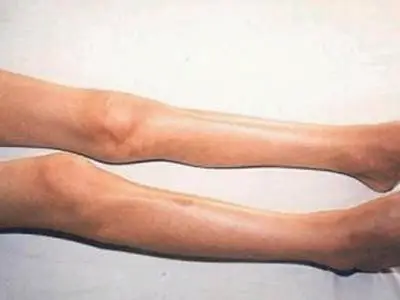 重症肌无力患者的症状表现是什么?