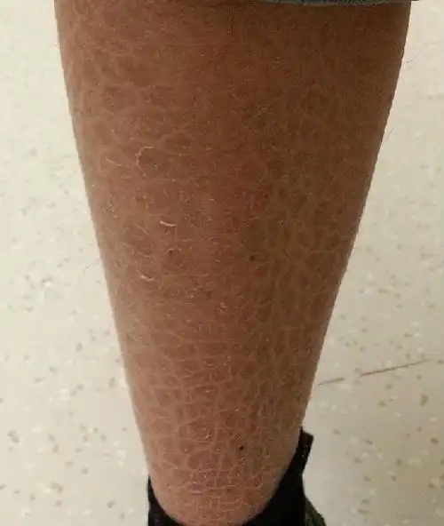 俗称牛皮癣,是一种具有一定遗传倾向的炎症性皮肤病,表现为境界清楚的